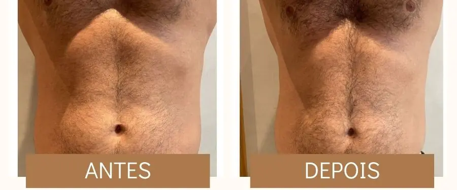 antes e depois 1